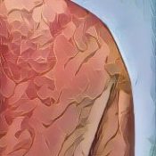 Folk Medicine and Remedies Sunburn